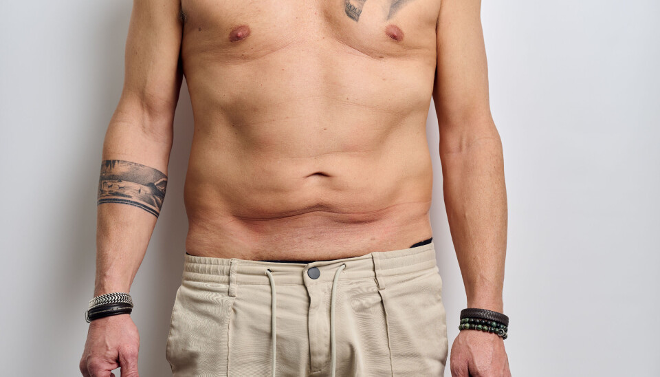 Weer in balans: over liposuctie & buikwandcorrectie Velthuis kliniek