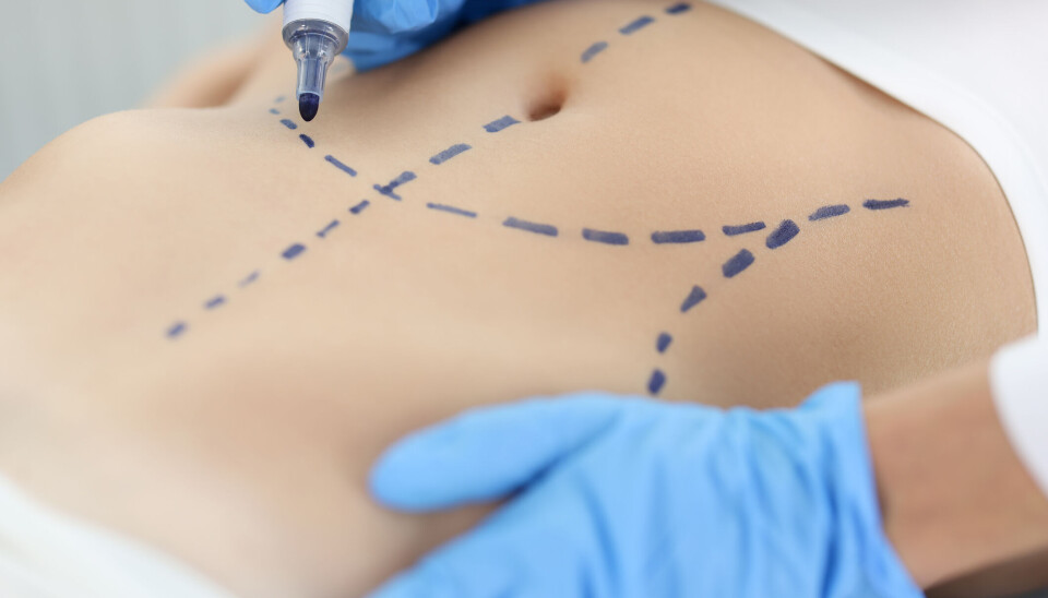 Weer in balans: over liposuctie & buikwandcorrectie